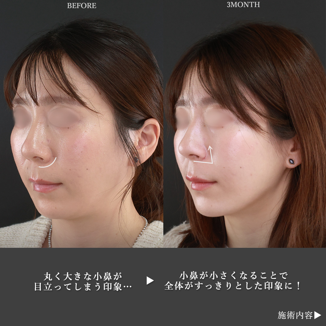 鼻孔縁挙上術/鼻翼挙上術/TAC式 鼻翼縮小術（小鼻縮小）の症例写真 施術前後 