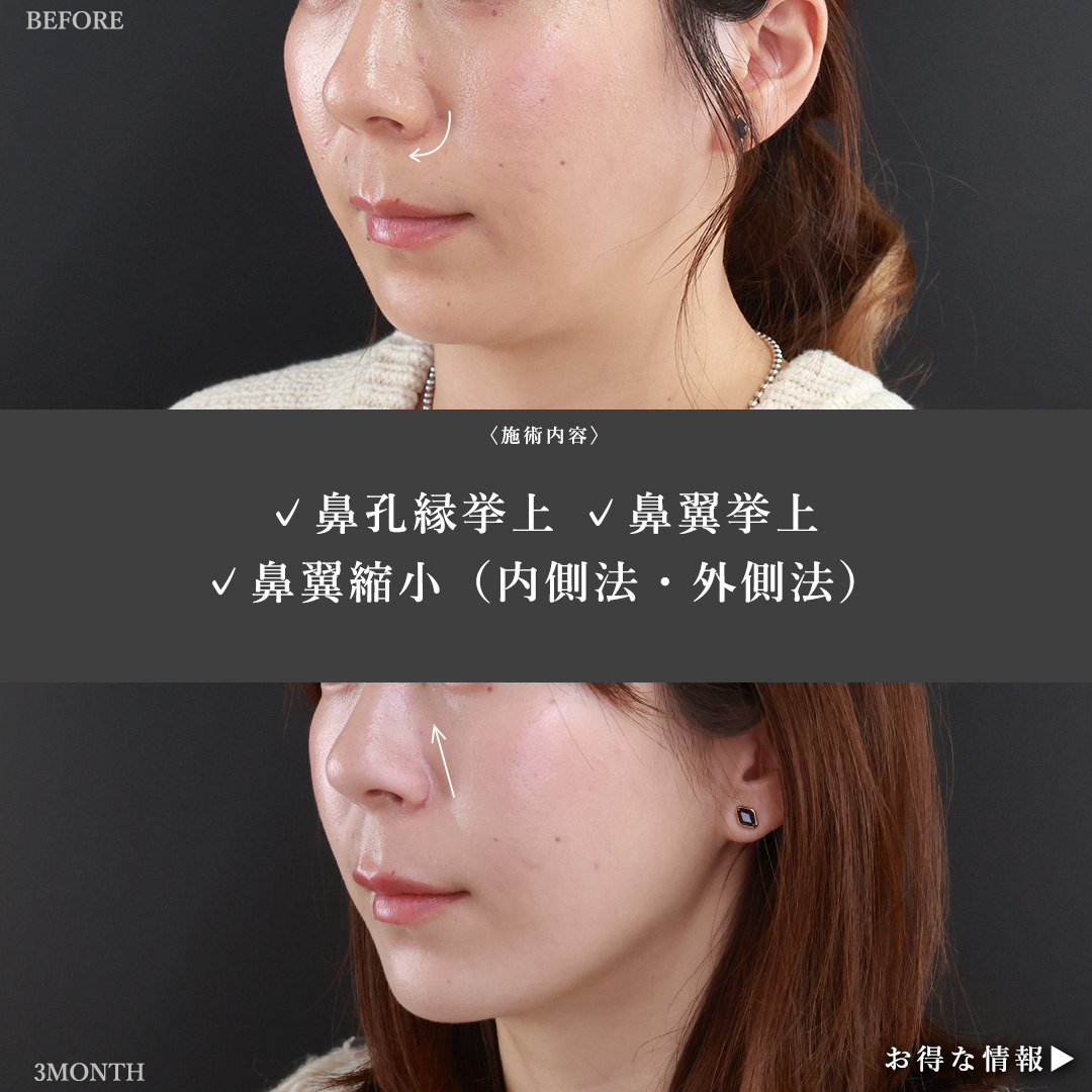 鼻孔縁挙上術/鼻翼挙上術/TAC式 鼻翼縮小術（小鼻縮小）の症例写真 施術前後 