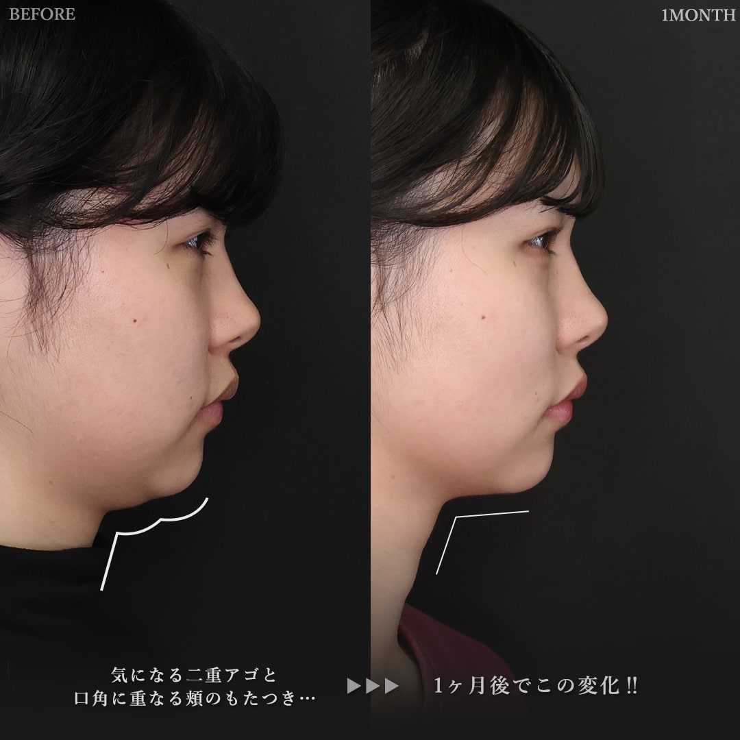 ジョールファット除去/顔の脂肪吸引/Lラインファット除去（エラ下脂肪除去）の症例写真 施術前後 