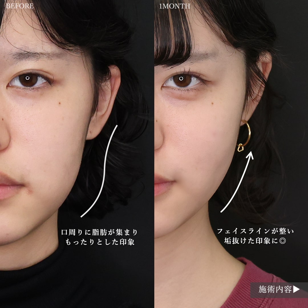 ジョールファット除去/顔の脂肪吸引/Lラインファット除去（エラ下脂肪除去）の症例写真 施術前後 