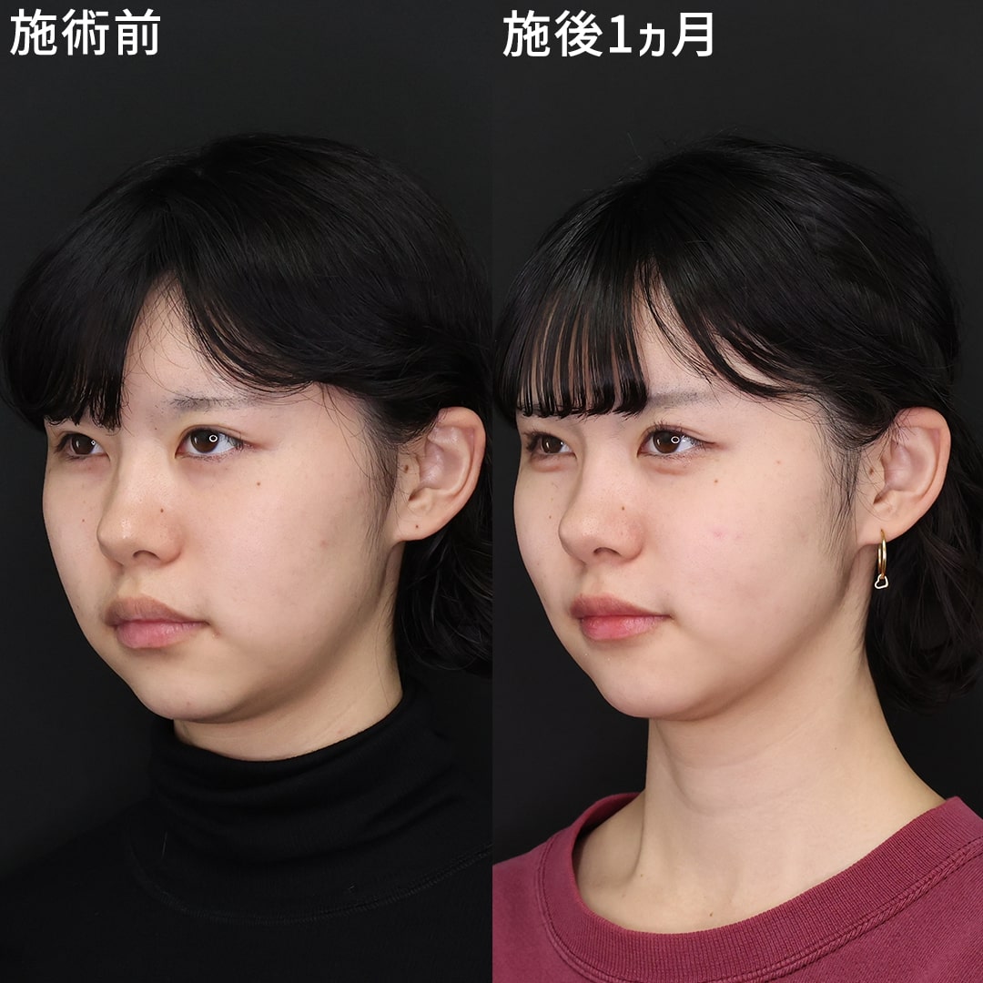 二重アゴ撃退！”垢抜け小顔術”