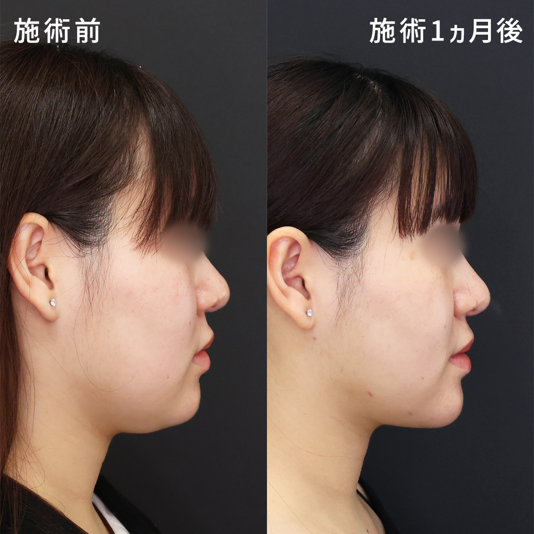 【顔の脂肪吸引】30分で二重顎を撃退