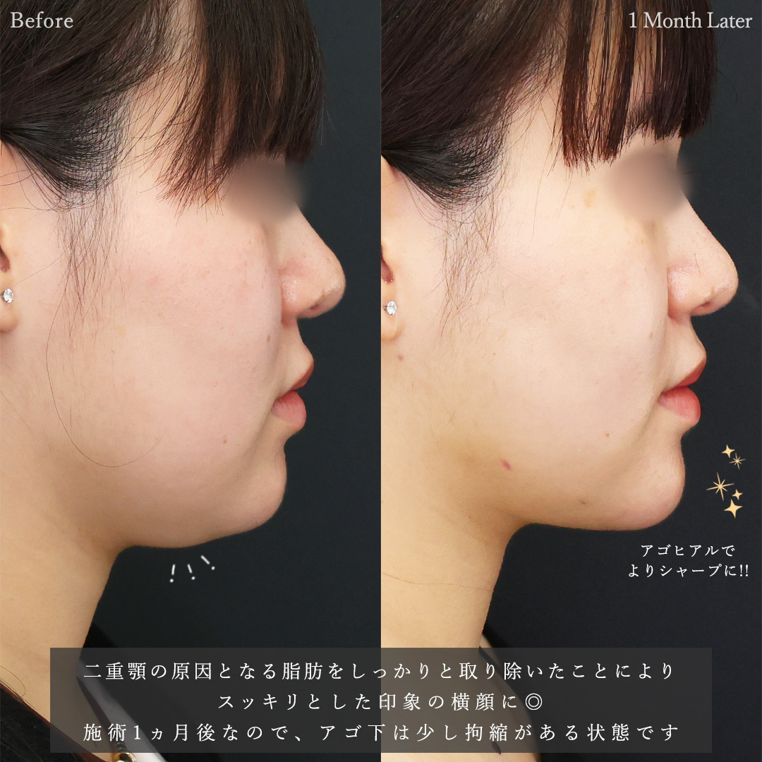 顎下の脂肪吸引/ジョールファット除去/メーラーファット除去の症例写真 施術前後 