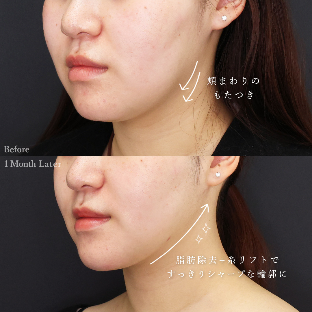 顎下の脂肪吸引/ジョールファット除去/メーラーファット除去の症例写真 施術前後 