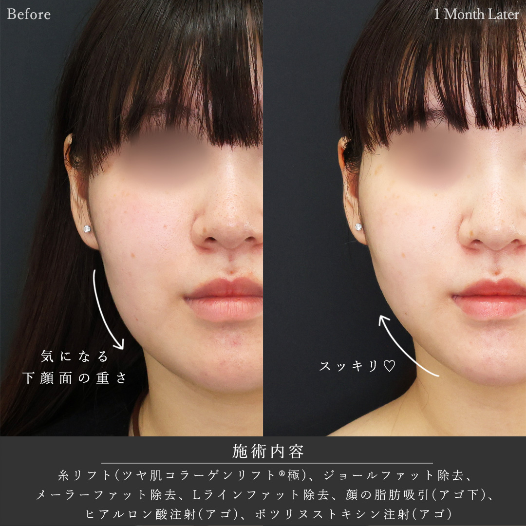 顎下の脂肪吸引/ジョールファット除去/メーラーファット除去の症例写真 施術前後 
