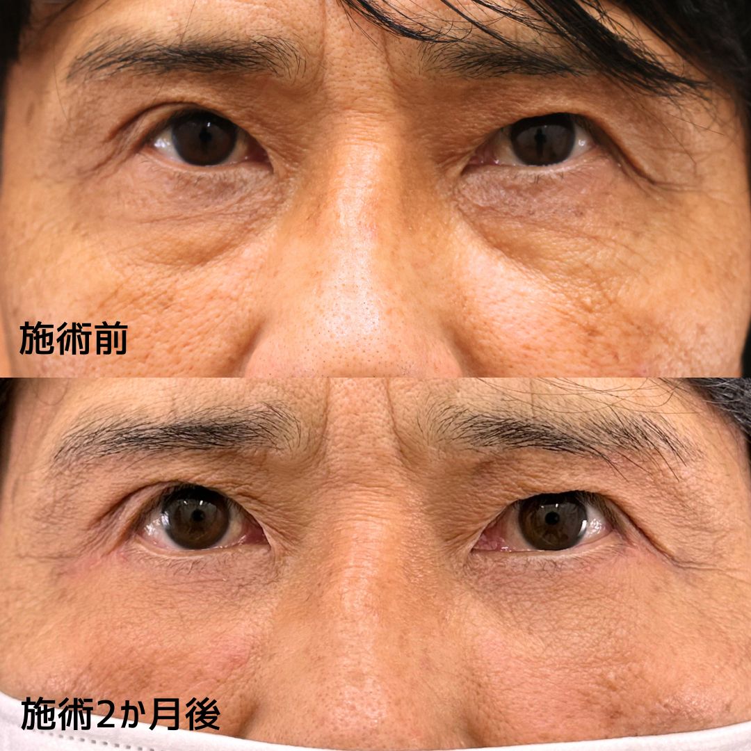 《50代男性美容》クマ取りで若々しく