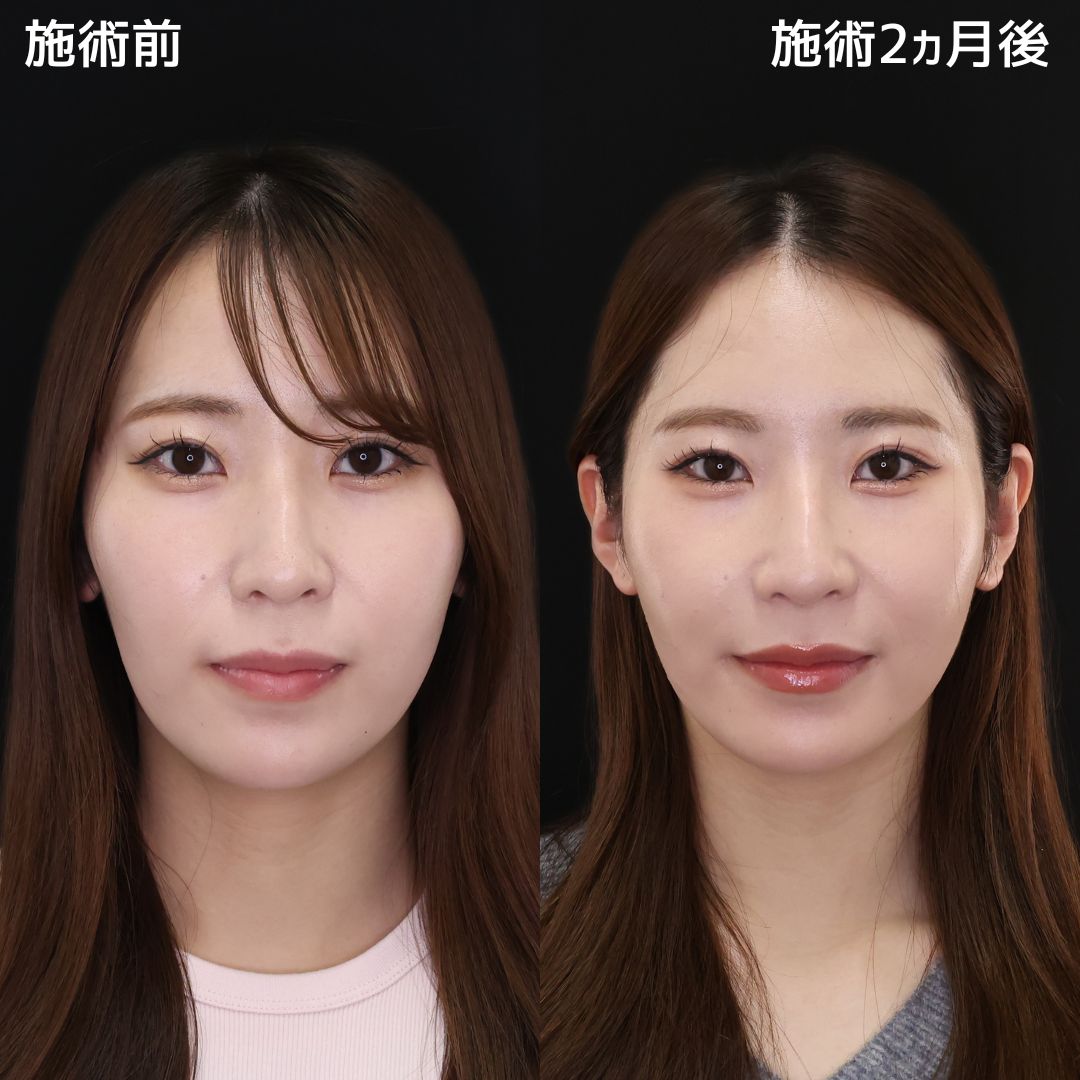 《小顔整形》バレずにナチュラル小顔になれました