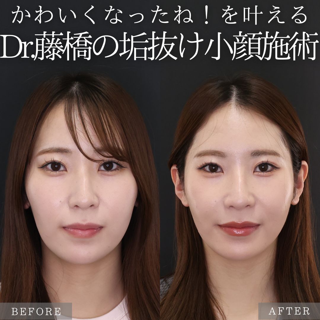 ジョールファット除去/ボトックス注射：その他/TAC式 ツヤ肌コラーゲンリフト®の症例写真 施術前後 