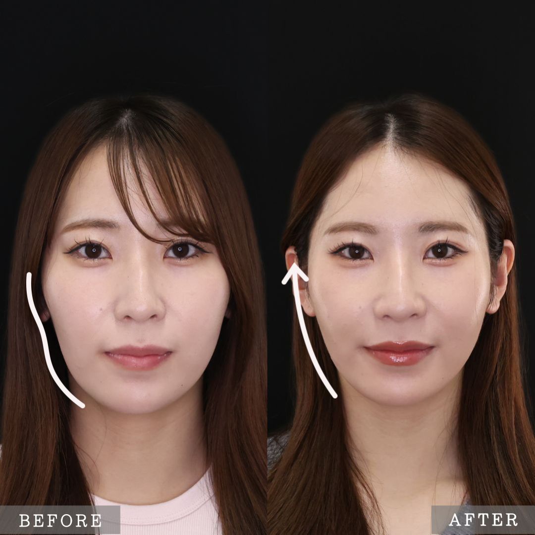 ジョールファット除去/ボトックス注射：その他/TAC式 ツヤ肌コラーゲンリフト®の症例写真 施術前後 