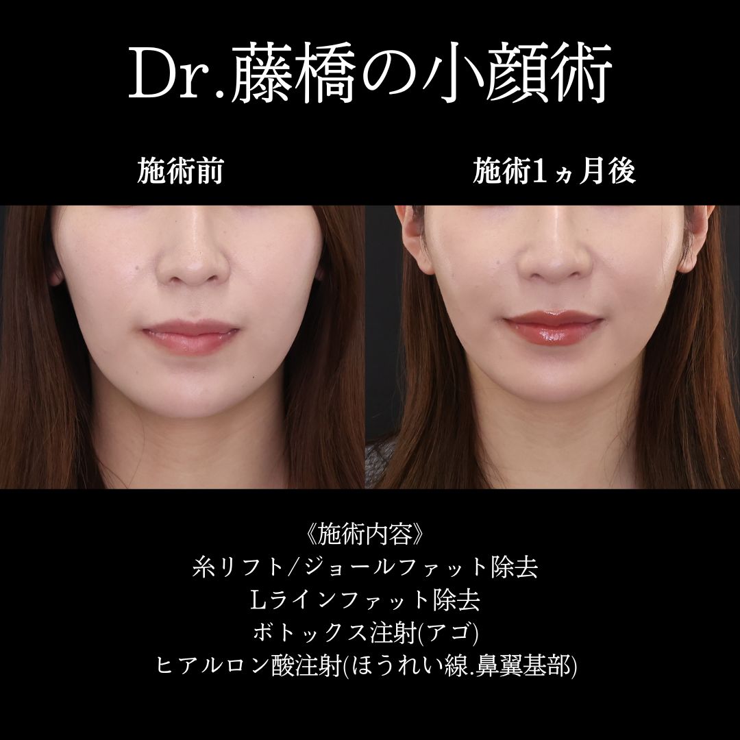 ジョールファット除去/ボトックス注射：その他/TAC式 ツヤ肌コラーゲンリフト®の症例写真 施術前後 