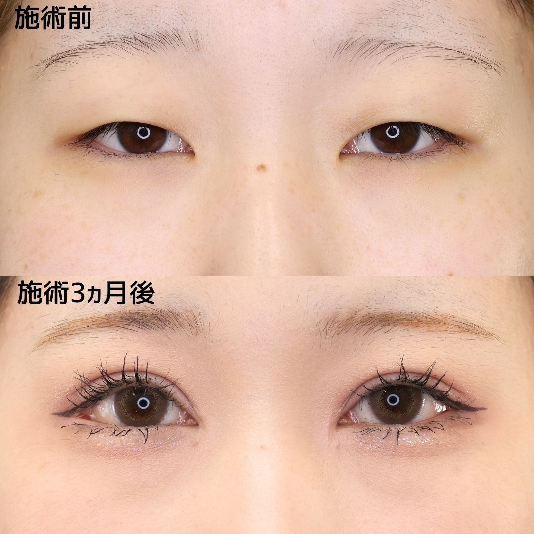 《目元整形》目元フルで別人級の魅力的なお目元へ