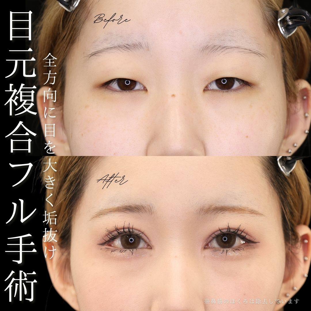 上眼瞼切開術/眼瞼下垂（目つき矯正）/目頭切開術の症例写真 施術前後 