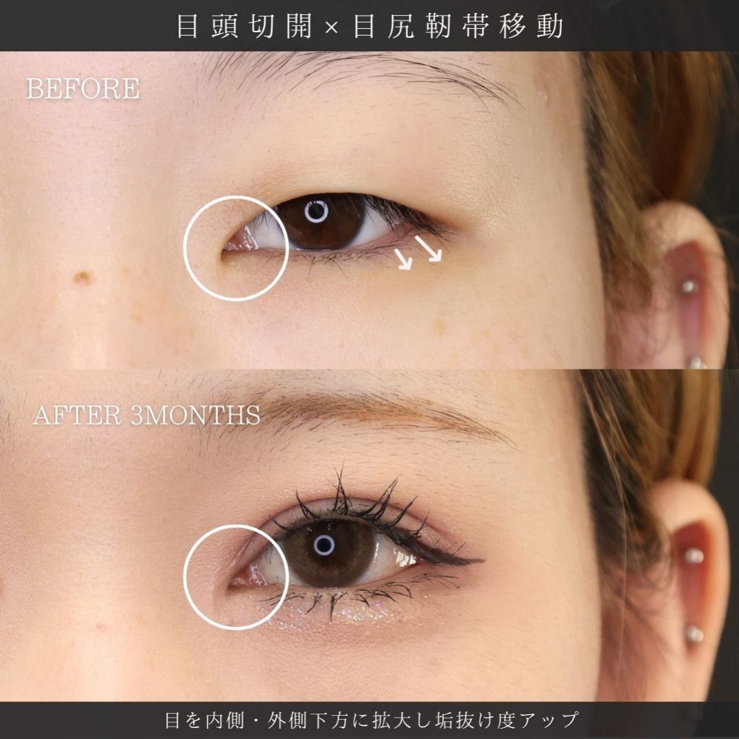 上眼瞼切開術/眼瞼下垂（目つき矯正）/目頭切開術の症例写真 施術前後 