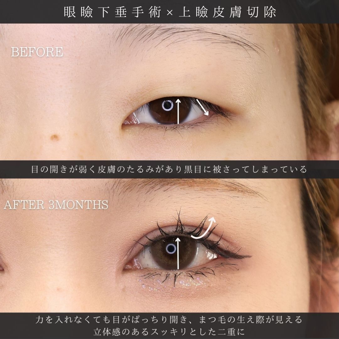 上眼瞼切開術/眼瞼下垂（目つき矯正）/目頭切開術の症例写真 施術前後 