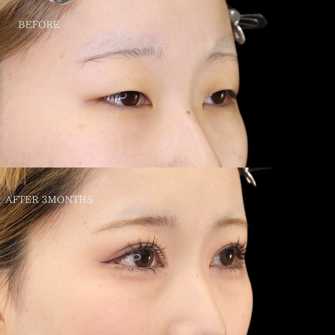 上眼瞼切開術/眼瞼下垂（目つき矯正）/目頭切開術の症例写真 施術前後 