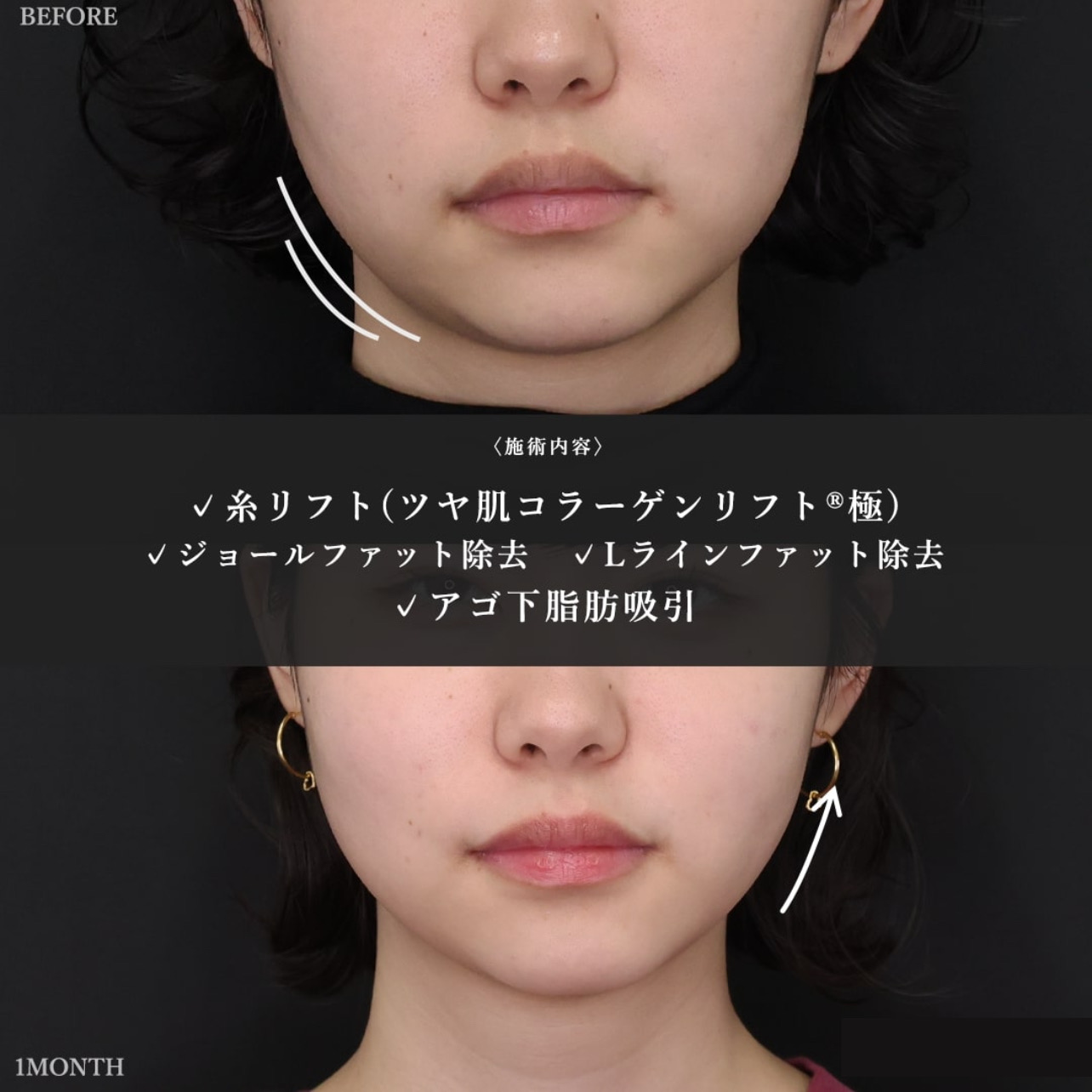 ジョールファット除去/顔の脂肪吸引/Lラインファット除去（エラ下脂肪除去）の症例写真 施術前後 