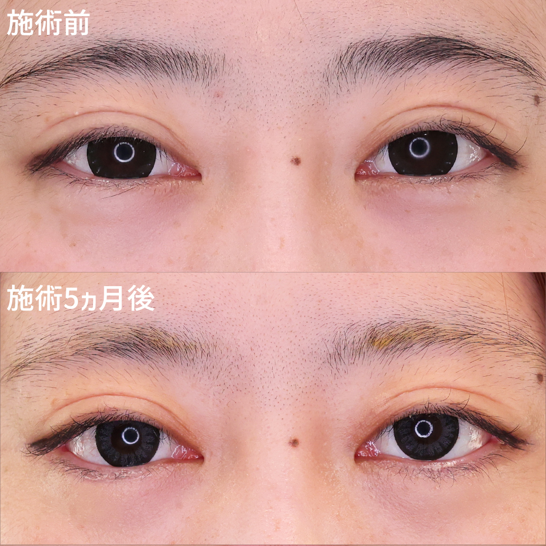 目尻切開とグラマラスラインで大きく印象的な目元に