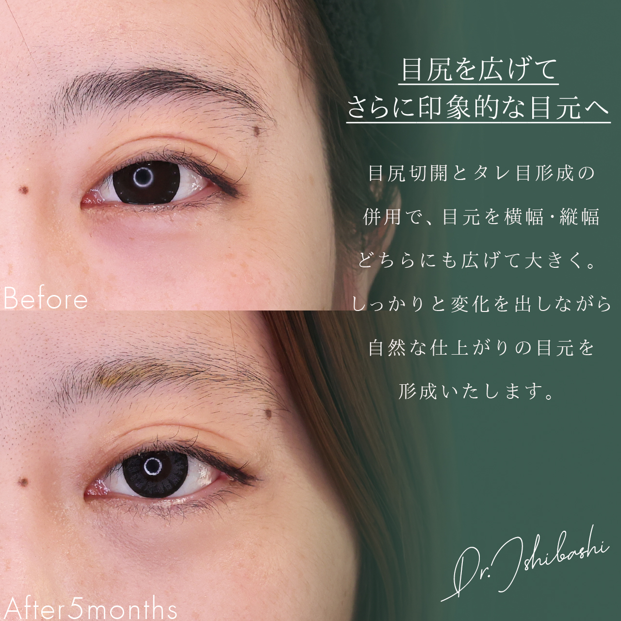 グラマラスライン（タレ目形成）/目尻切開術の症例写真 施術前後 