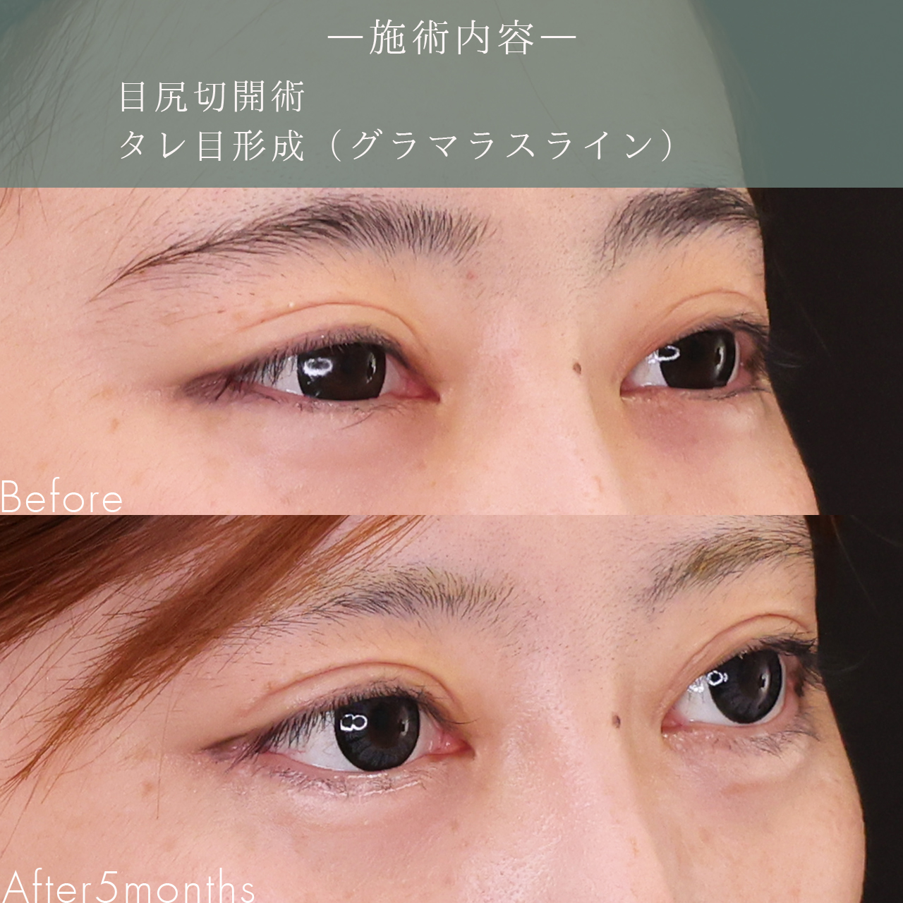 グラマラスライン（タレ目形成）/目尻切開術の症例写真 施術前後 
