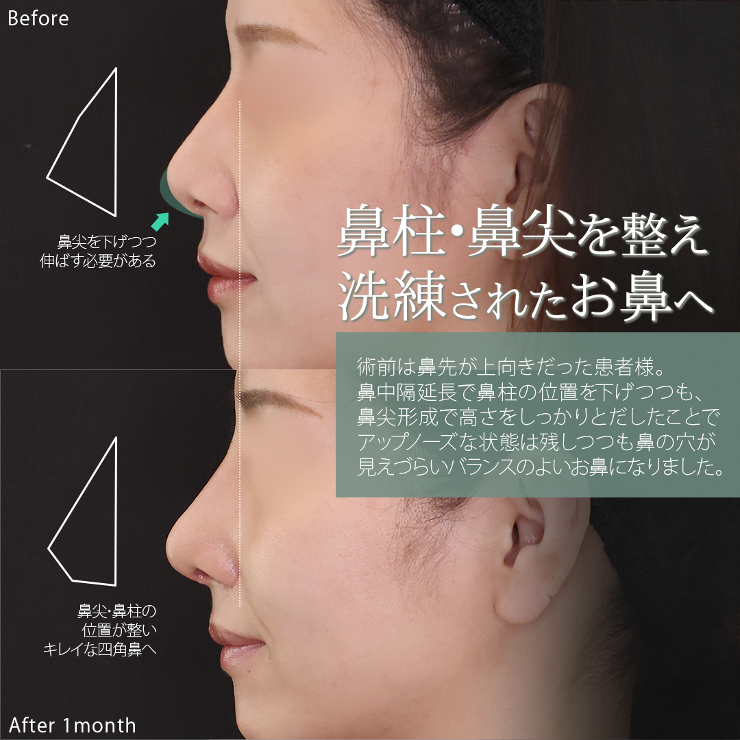 鼻尖形成・鼻尖縮小/鼻先軟骨移植/鼻中隔延長術の症例写真 施術前後