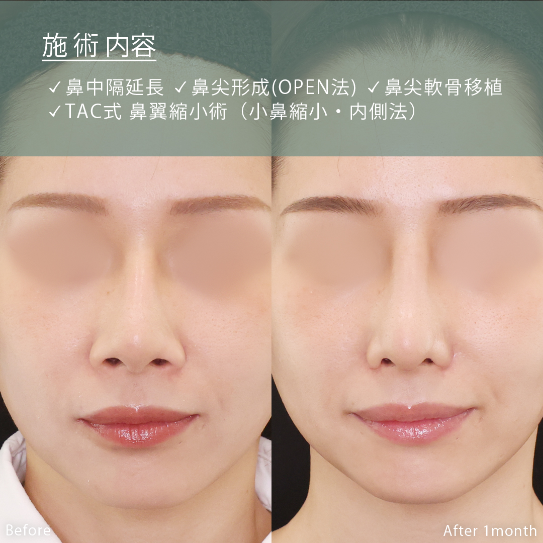 鼻尖形成・鼻尖縮小/鼻先軟骨移植/鼻中隔延長術の症例写真 施術前後