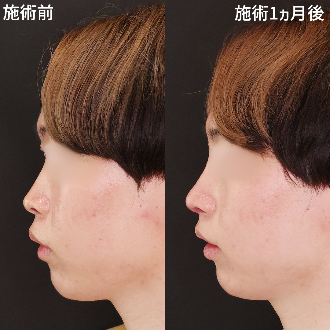 鼻中隔延長術/隆鼻術(プロテーゼ・自家組織)/鼻尖形成・鼻尖縮小の症例写真 施術前後