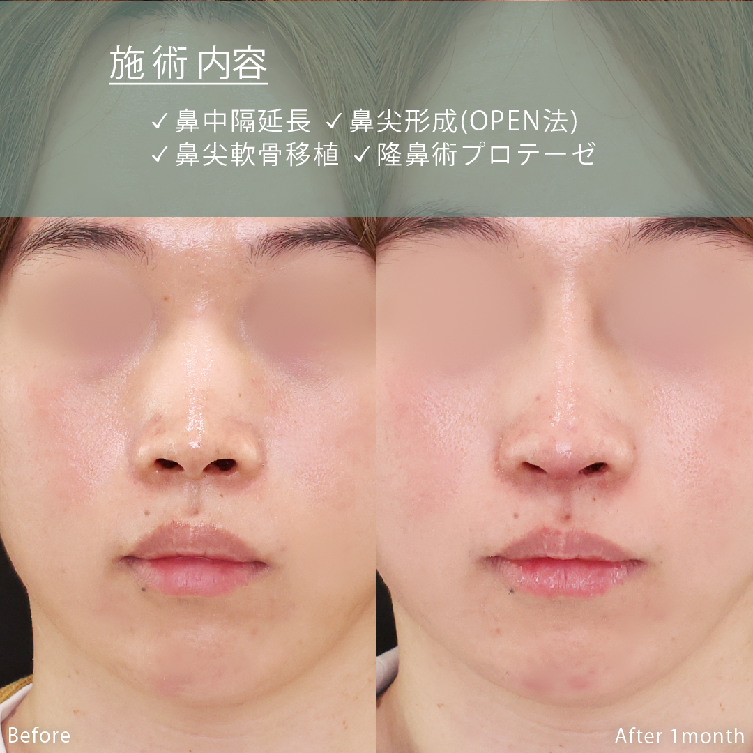 鼻中隔延長術/隆鼻術(プロテーゼ・自家組織)/鼻尖形成・鼻尖縮小の症例写真 施術前後