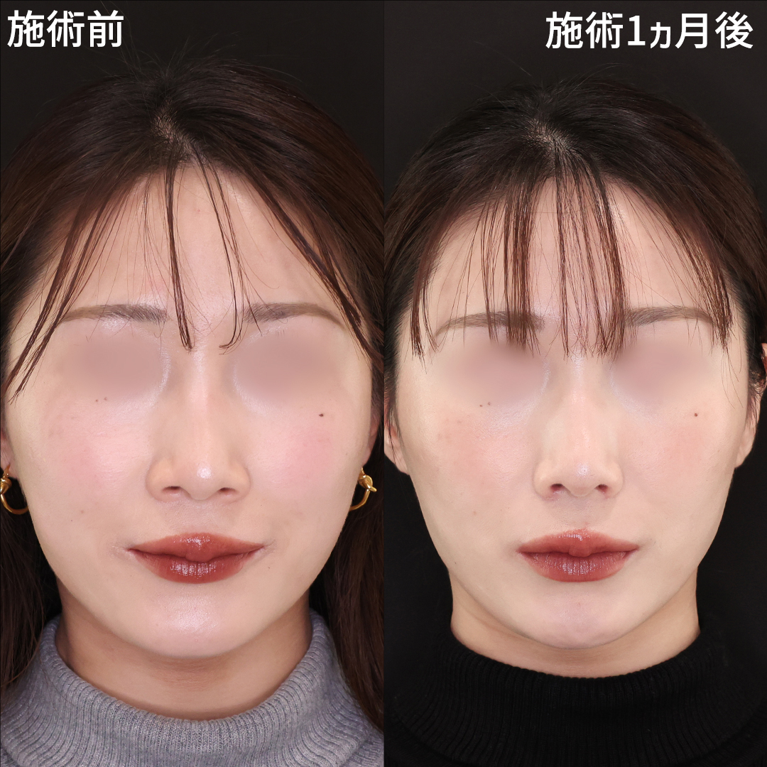 小鼻縮小 20代の症例写真・画像・ビフォーアフター｜美容整形