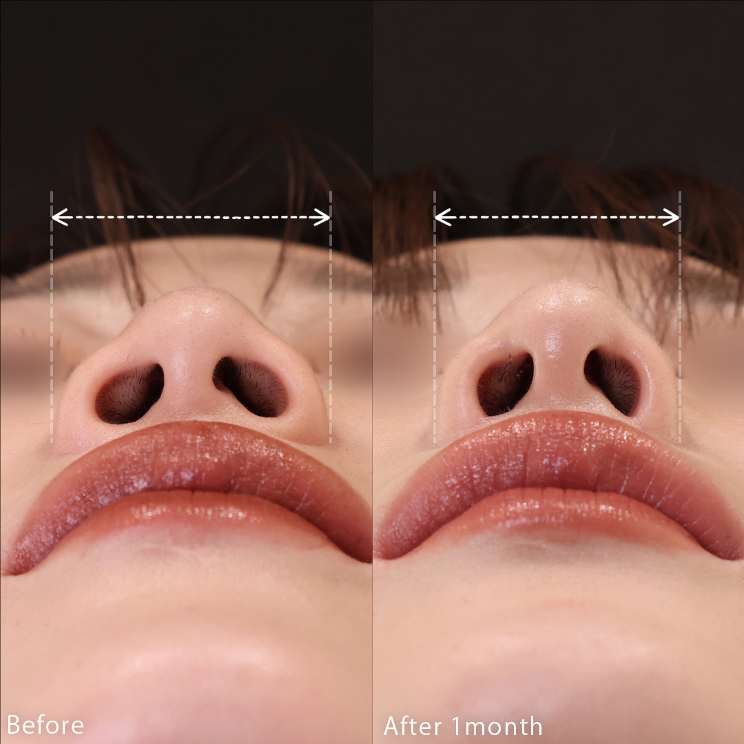 TAC式 鼻翼縮小術(小鼻縮小)の症例写真 施術前後