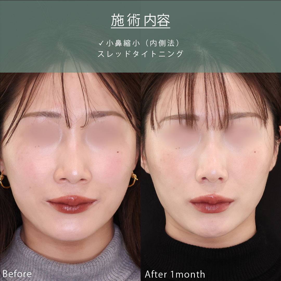 TAC式 鼻翼縮小術(小鼻縮小)の症例写真 施術前後