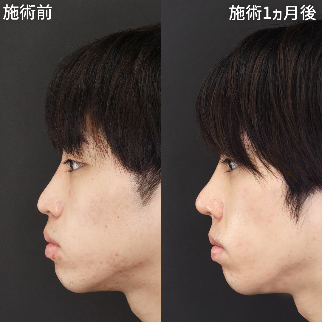 鼻中隔延長で立体感のある凛々しい横顔に！