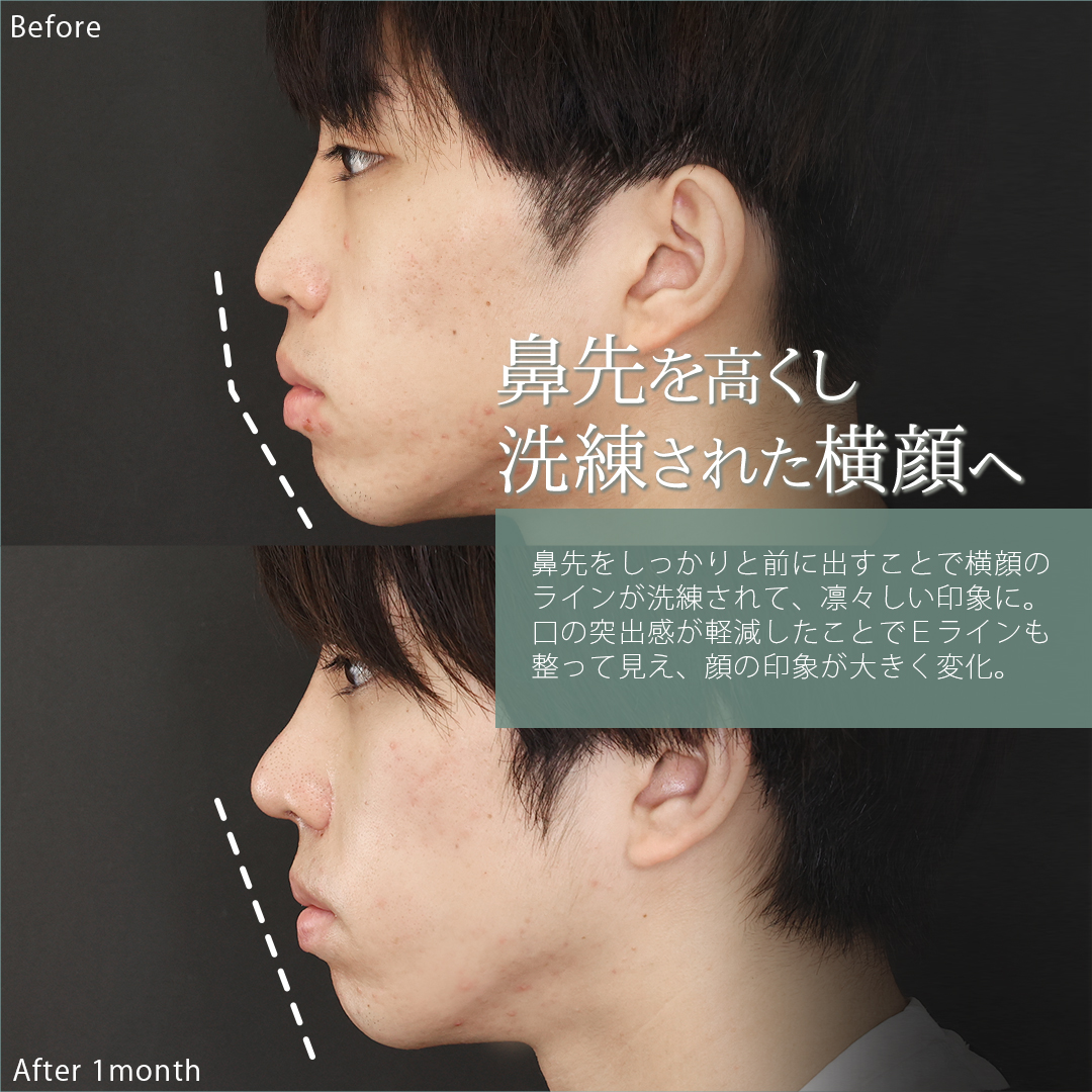 鼻中隔延長術/鼻尖形成・鼻尖縮小/鼻先軟骨移植の症例写真 施術前後 