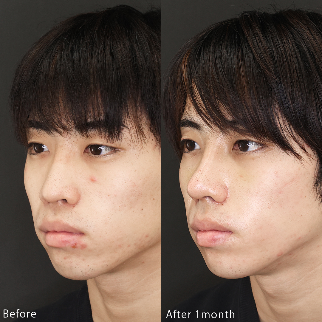 鼻中隔延長術/鼻尖形成・鼻尖縮小/鼻先軟骨移植の症例写真 施術前後 