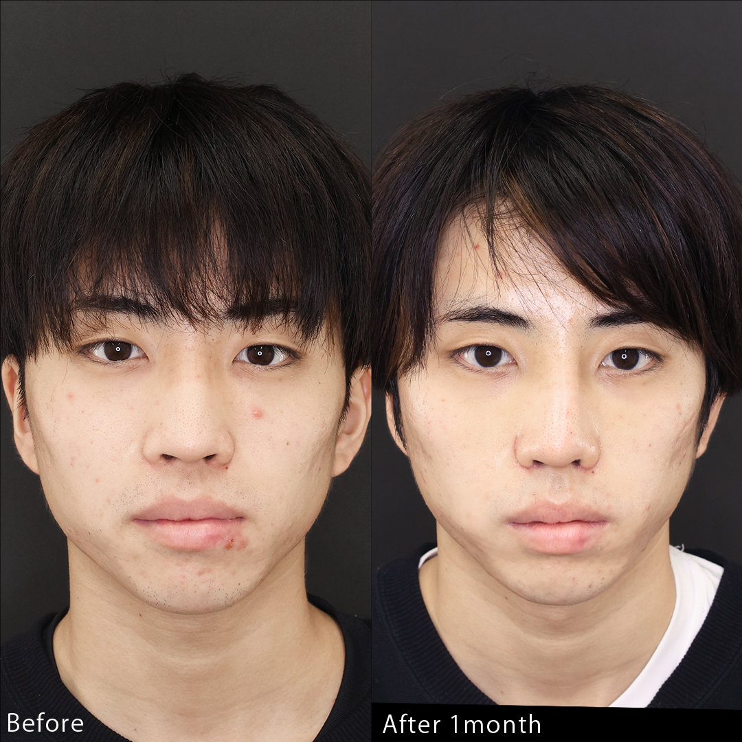 鼻中隔延長術/鼻尖形成・鼻尖縮小/鼻先軟骨移植の症例写真 施術前後 