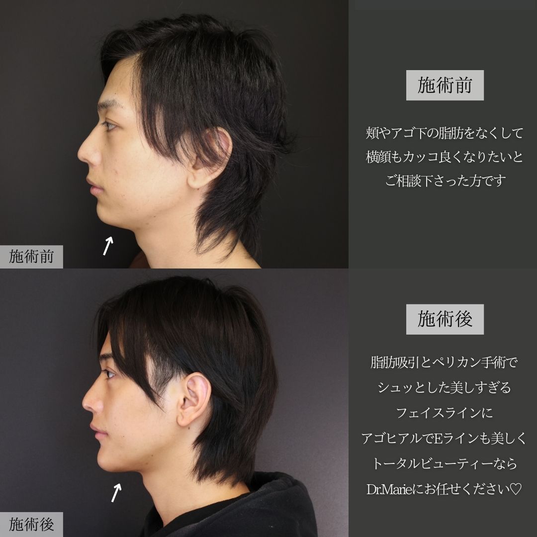 顔の脂肪吸引/TAC式 ツヤ肌コラーゲンリフト®/人中短縮術(リップリフト)・外側人中短縮術の症例写真 施術前後 