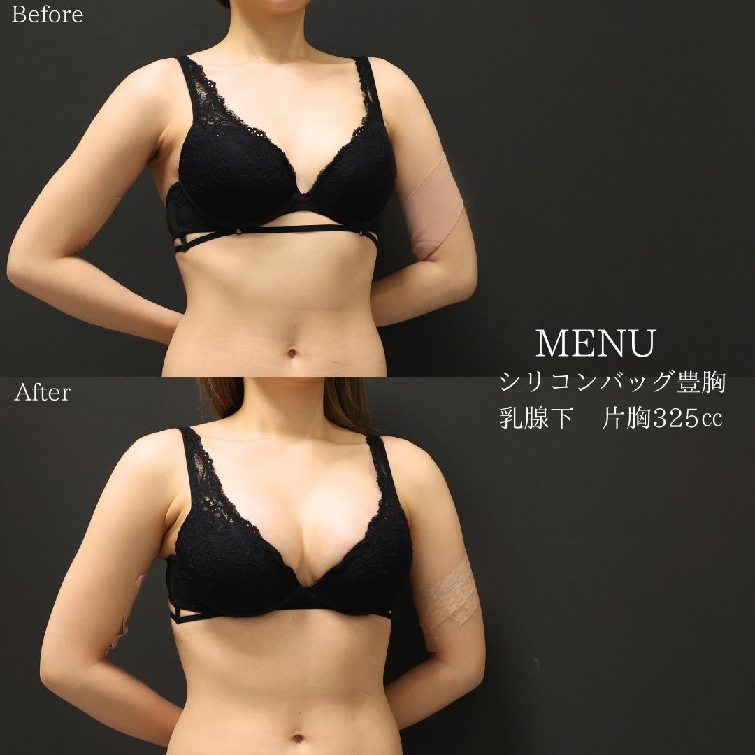 シリコンバッグ豊胸(人工乳腺バッグ)の症例写真 施術前後