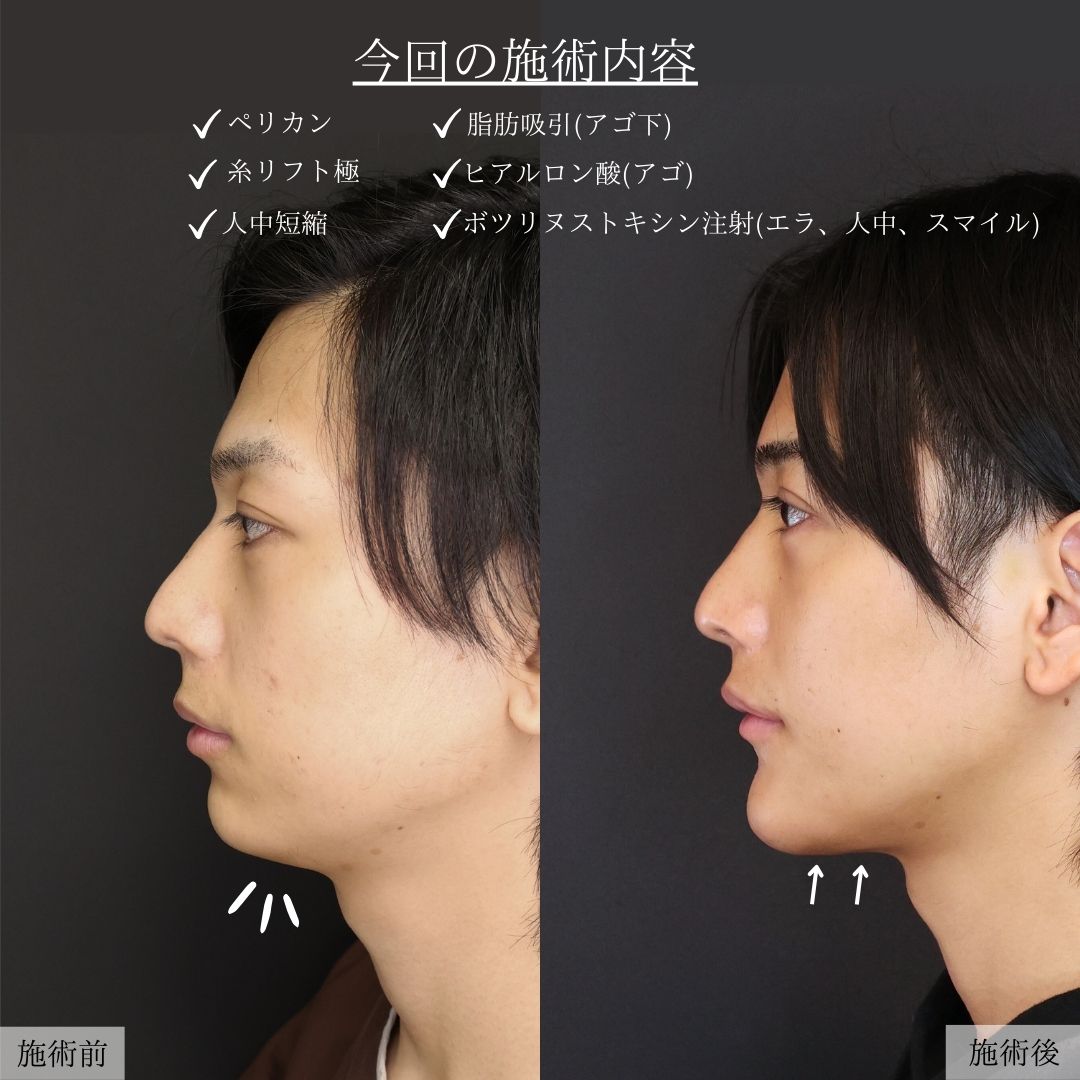 顔の脂肪吸引/TAC式 ツヤ肌コラーゲンリフト®/人中短縮術(リップリフト)・外側人中短縮術の症例写真 施術前後 