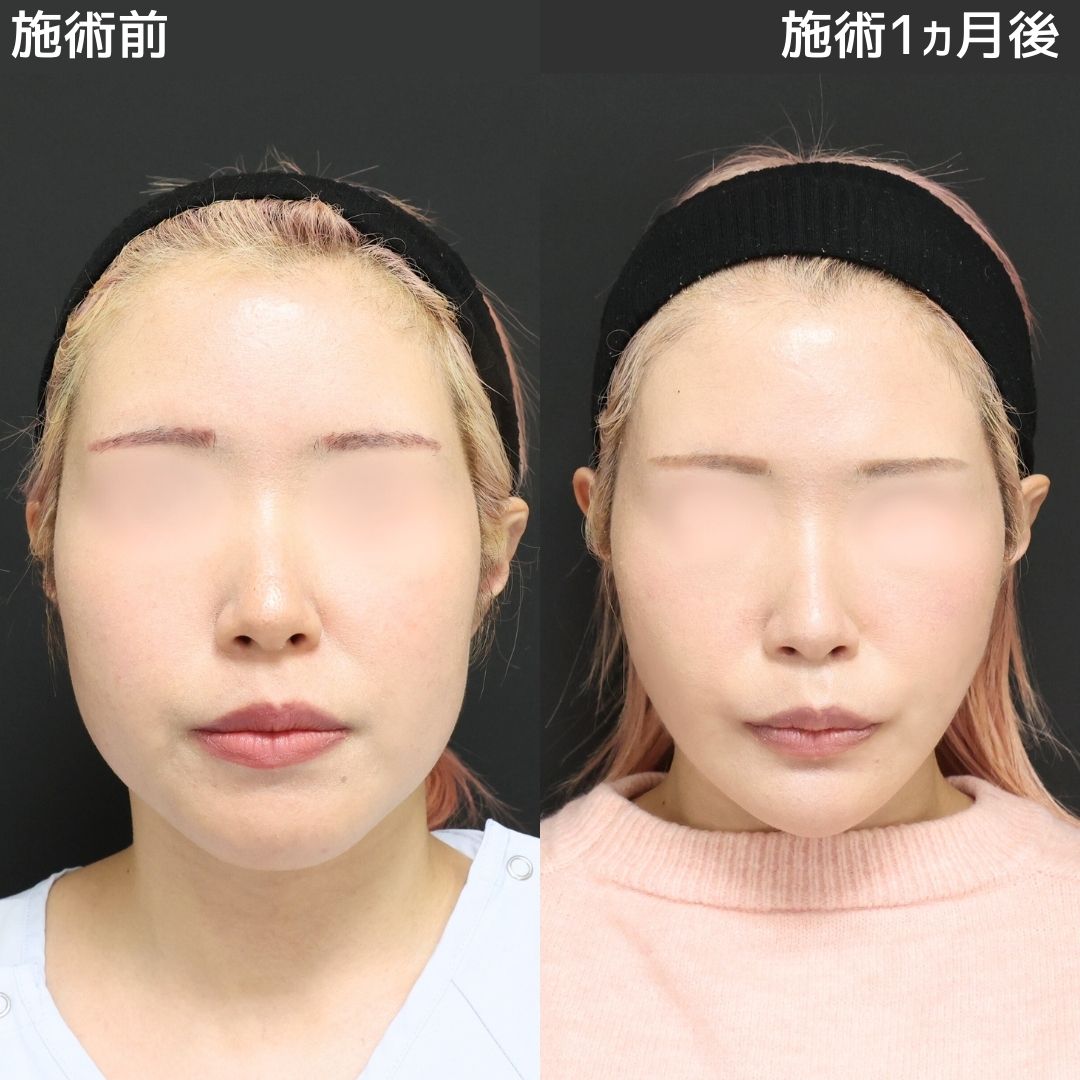 《小顔整形》もう顔の余白なんて気になりません