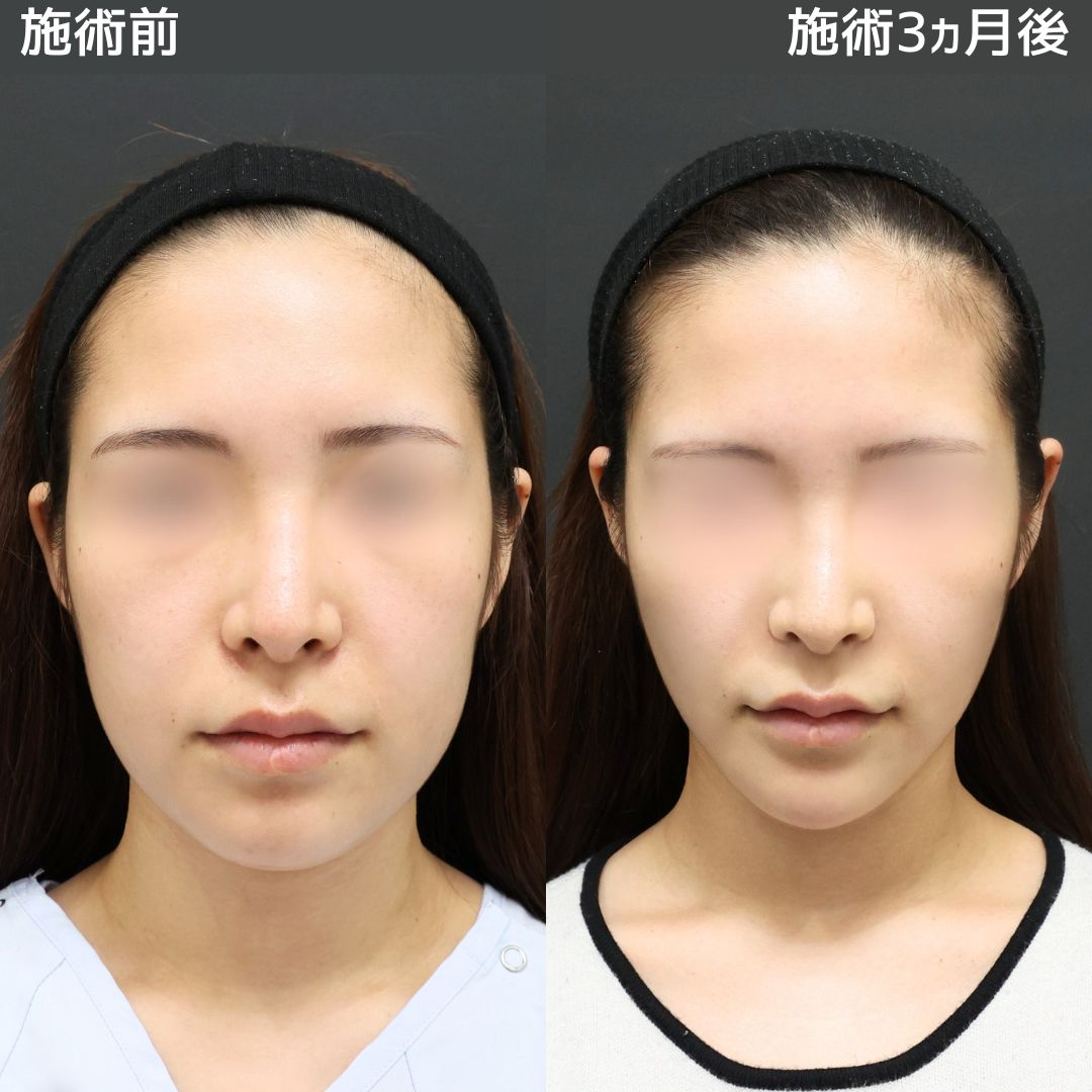 《小顔整形》モデル級の小顔になれて本当にやってよかった！