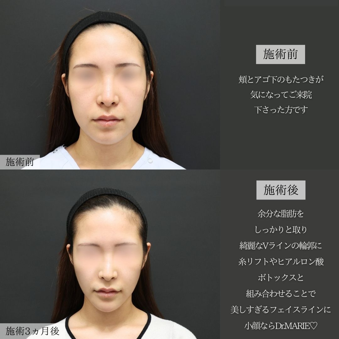 バッカルファット除去/ジョールファット除去/Lラインファット除去（エラ下脂肪除去）の症例写真 施術前後 