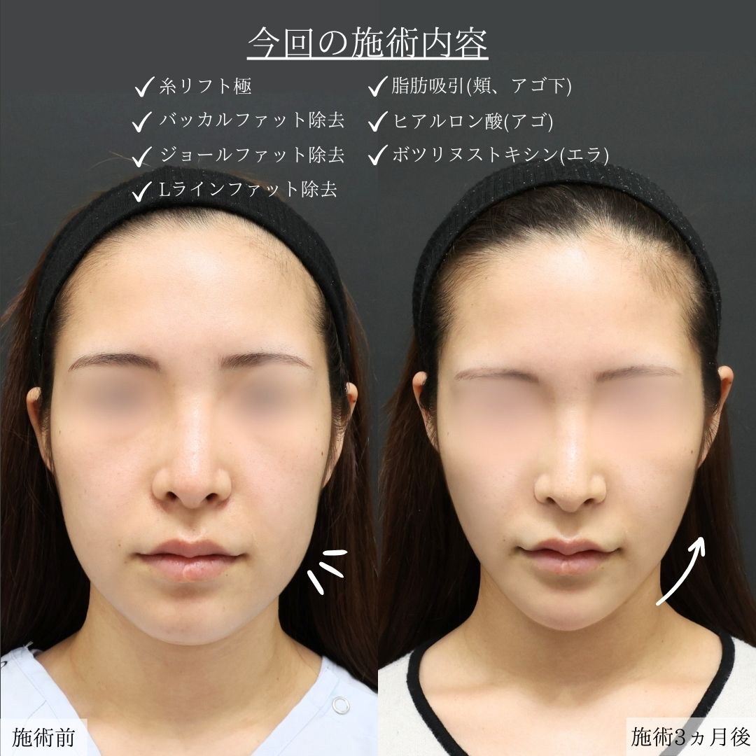 バッカルファット除去/ジョールファット除去/Lラインファット除去（エラ下脂肪除去）の症例写真 施術前後 
