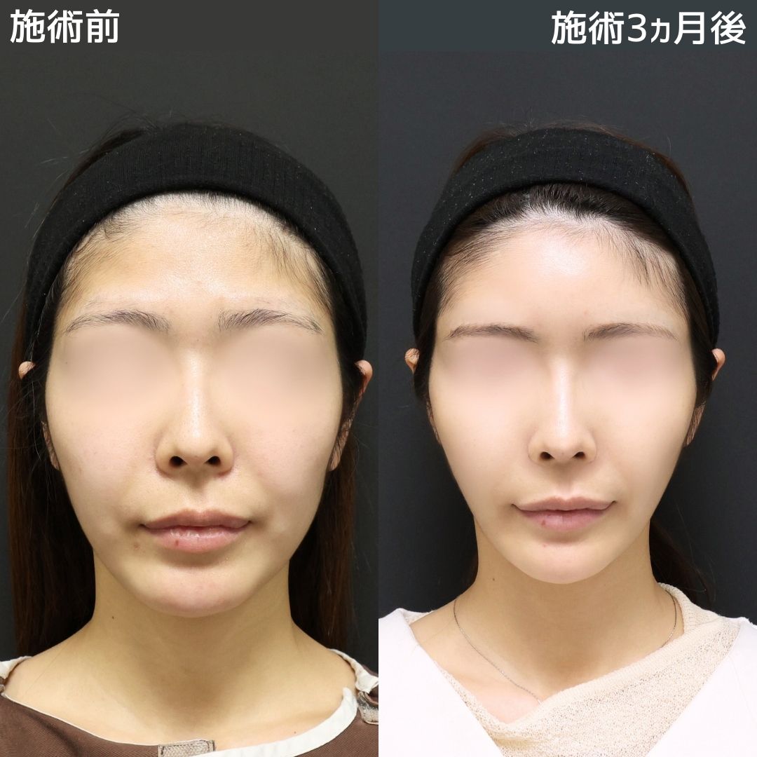 《小顔整形》もたつきゼロのフェイスラインになりました