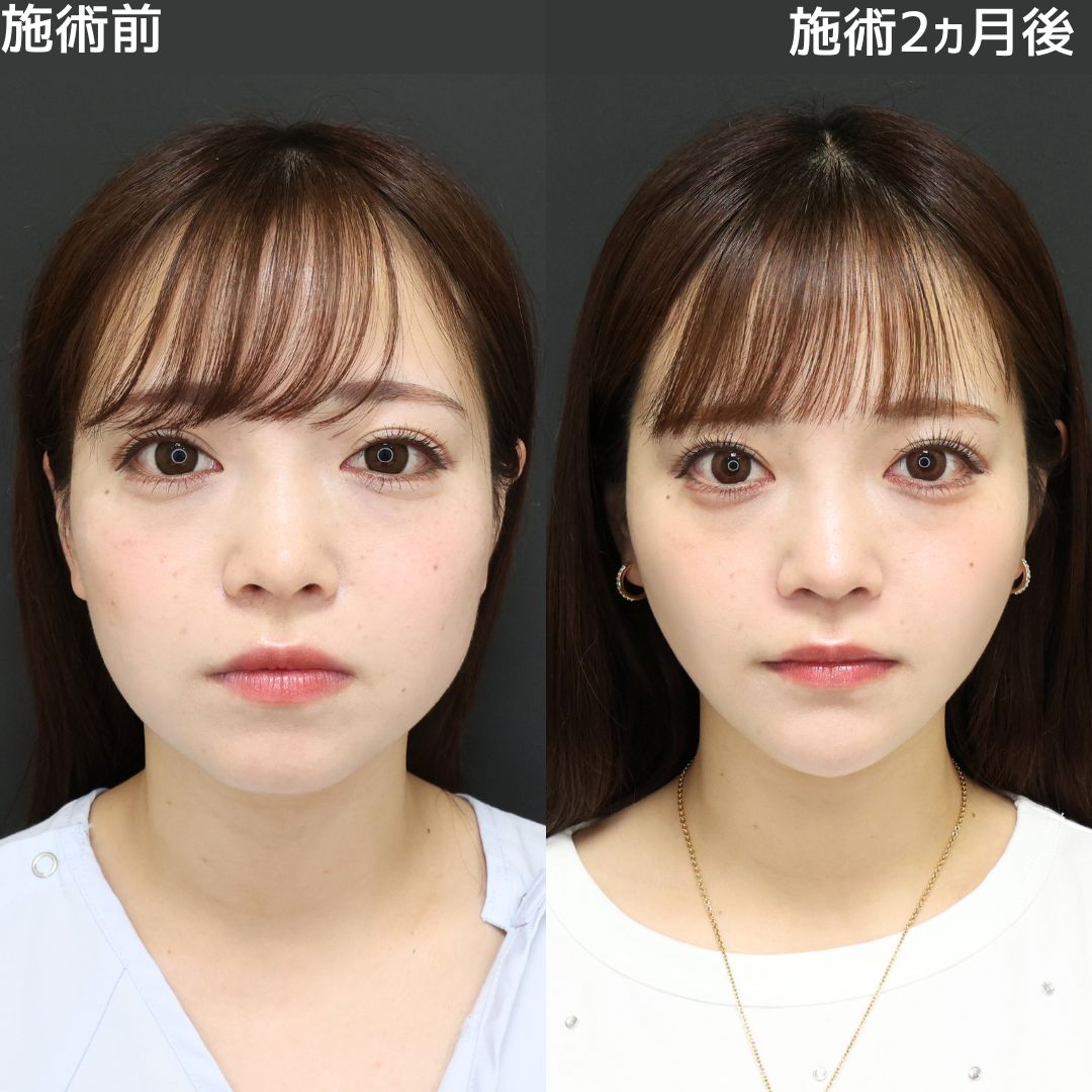 《パーフェクトフェイスライン》まりえ先生に理想の輪郭にしてもらいました