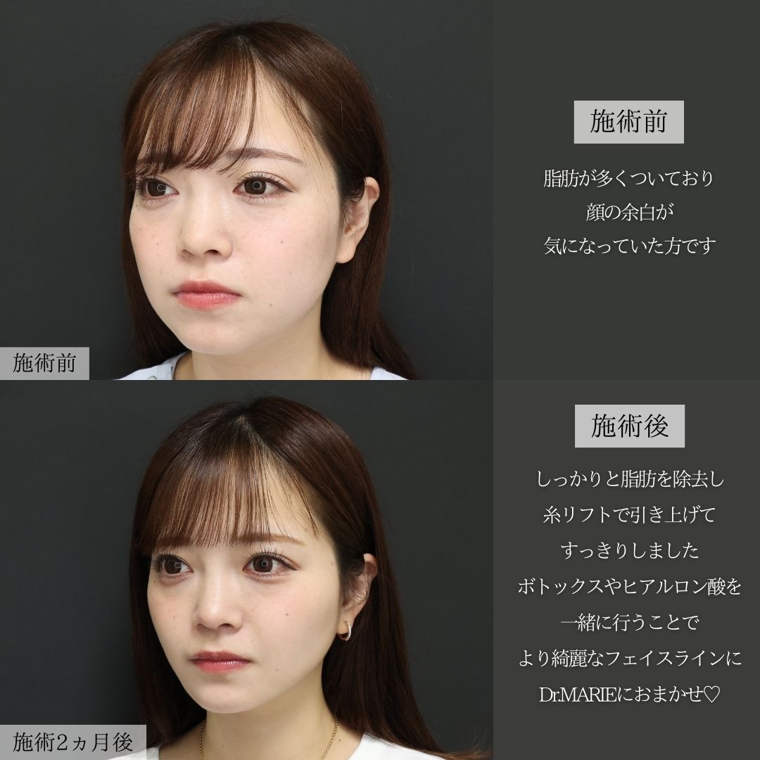 TAC式 ツヤ肌コラーゲンリフト®/バッカルファット除去/ジョールファット除去の症例写真 施術前後 