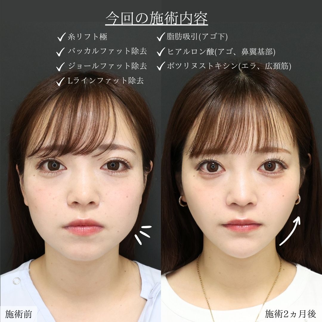TAC式 ツヤ肌コラーゲンリフト®/バッカルファット除去/ジョールファット除去の症例写真 施術前後 