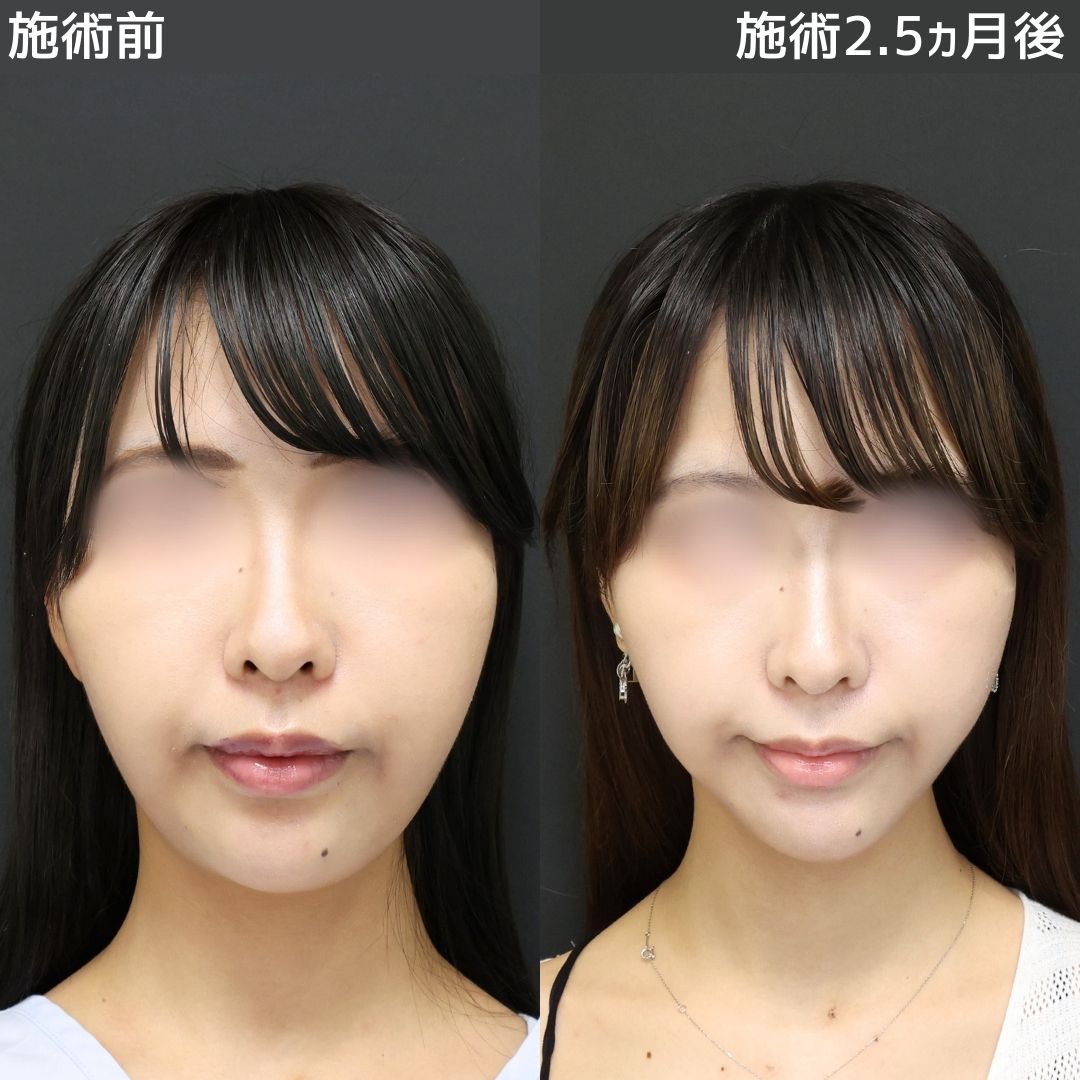 《小顔整形》まりえ先生の圧倒的技術力に感動しました
