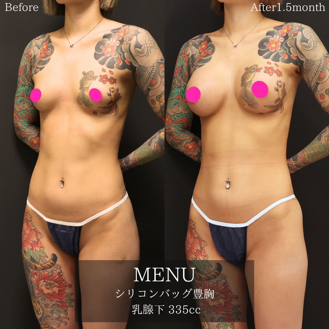 シリコンバッグ豊胸（人工乳腺バッグ）の症例写真 施術前後 