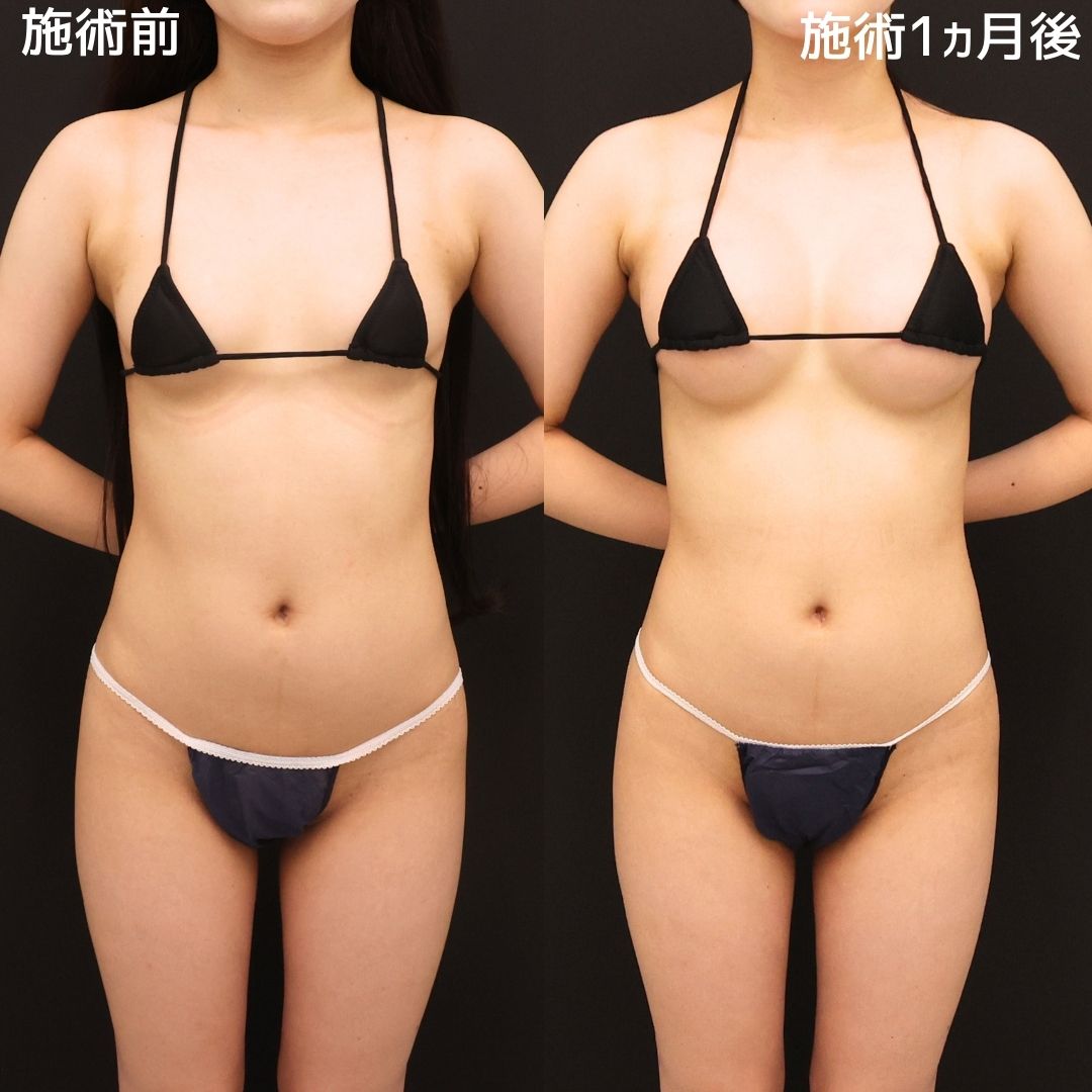 《シリコンバッグ豊胸》コンプレックスだった胸から自慢の胸に変わりました