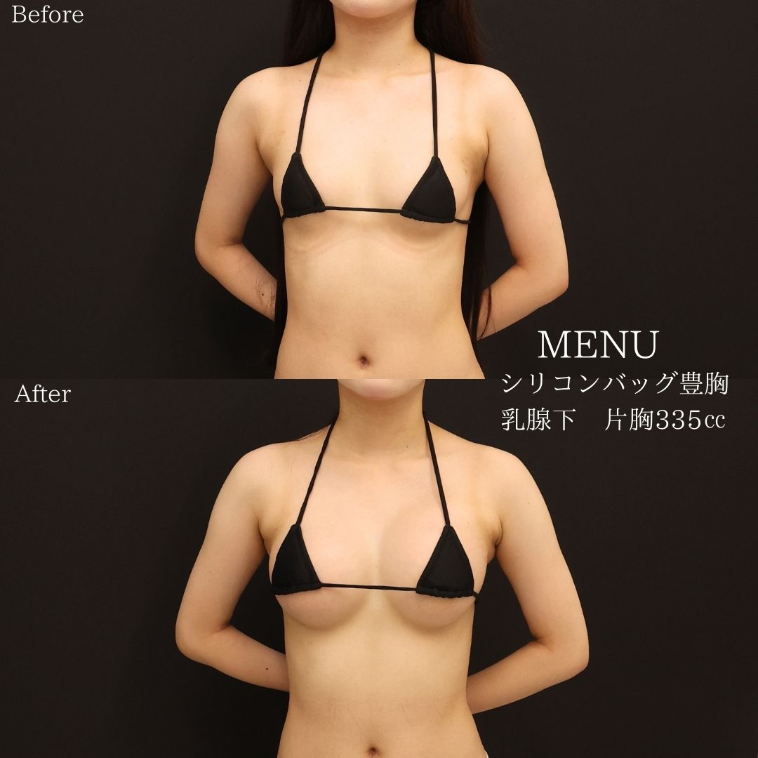 シリコンバッグ豊胸（人工乳腺バッグ）/ボトックス注射：その他の症例写真 施術前後 