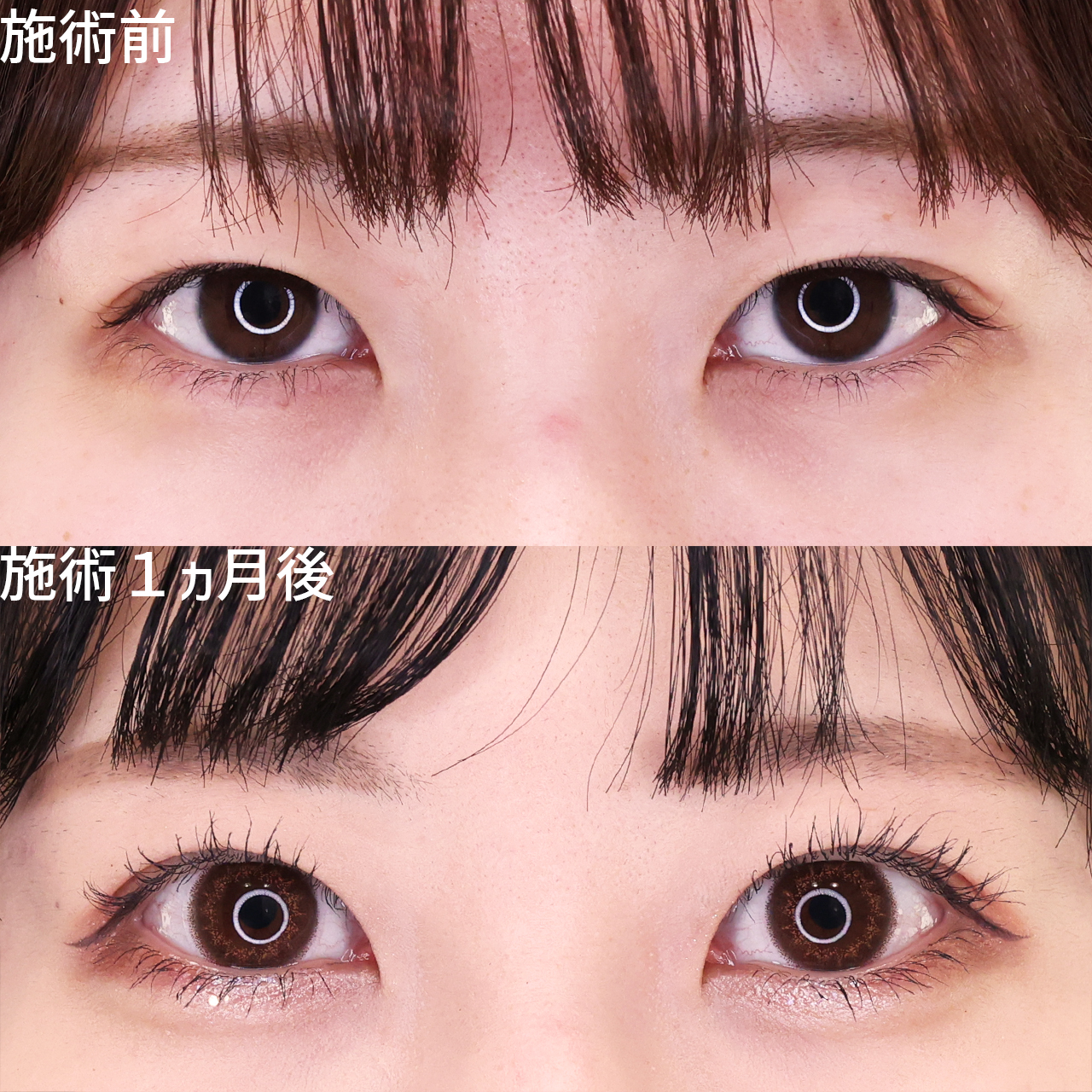 クイックコスメリングの症例写真 施術前後